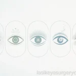 Types of laser vision correction — featured image